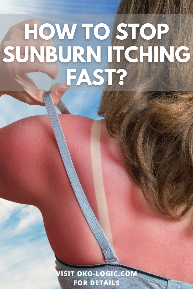 How to Get Rid of Sunburn Itching with an Easy and 100% Natural DIY Spray