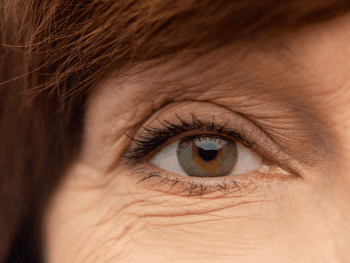 aging woman's partial face who needs to tighten skin under eyes